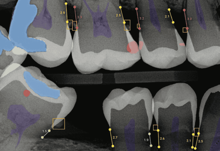 From Plaque Disclosure to Real-Time, At-Home Feedback: How AI Is Changing Patient Coaching in Dentistry
