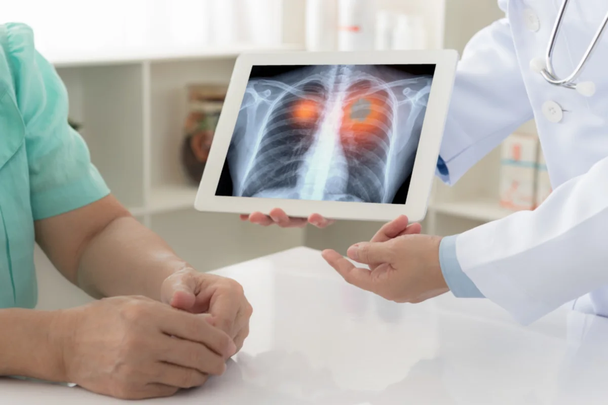 Advancing Access to Lung Cancer Care Through Artificial Intelligence Innovation