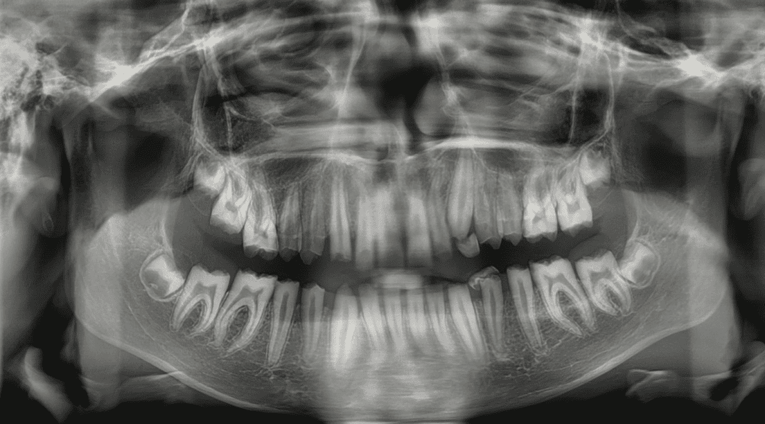 Full-Mouth Rehabilitation in an Adolescent With Amelogenesis Imperfecta